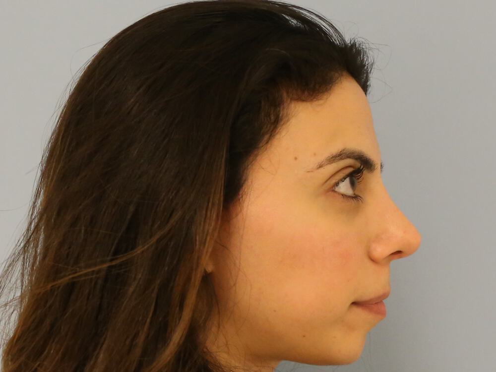 Nose reshaping women Before & After Image