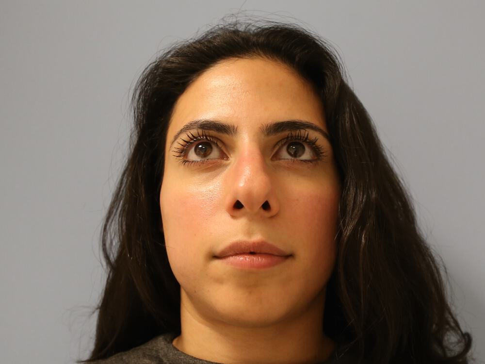 Nose reshaping women Before & After Image