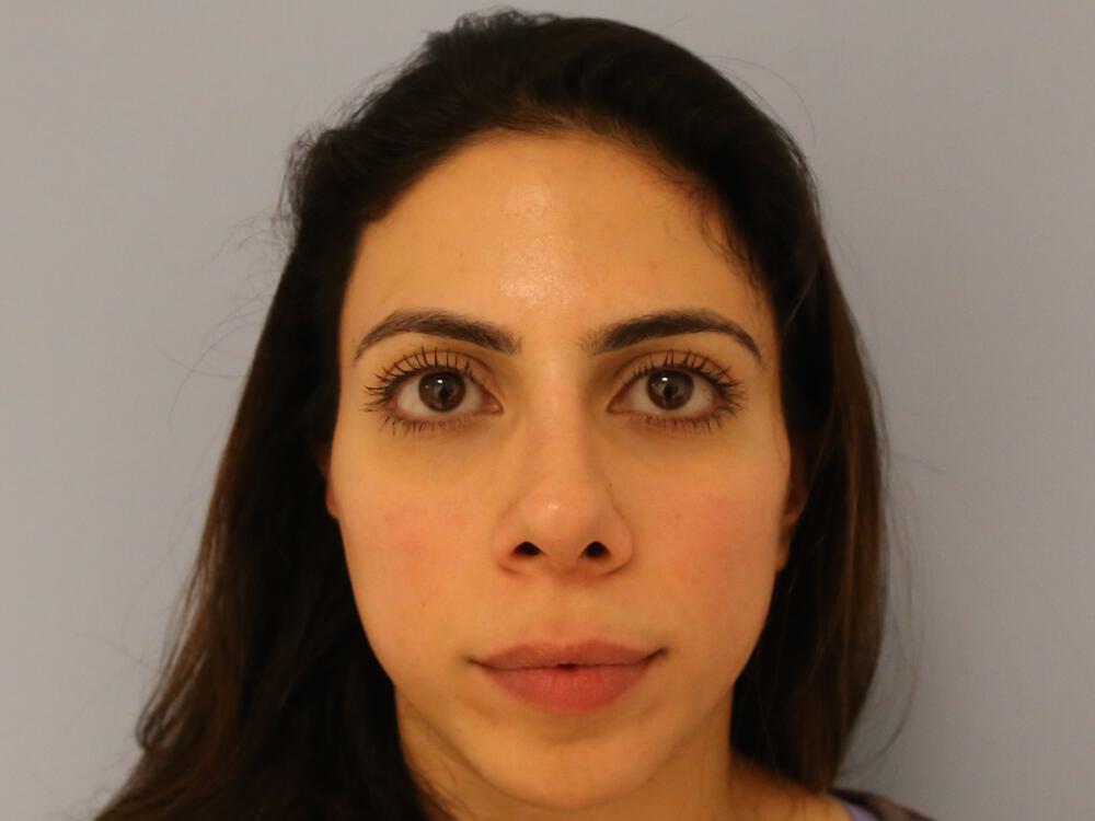 Nose reshaping women Before & After Image