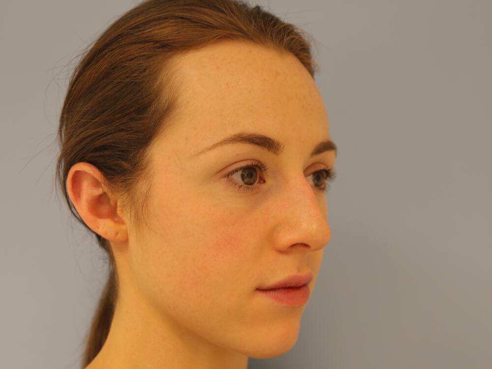 Nose reshaping women Before & After Image