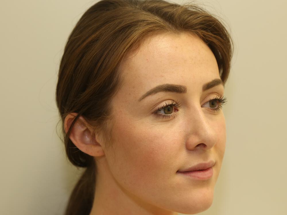 Nose reshaping women Before & After Image