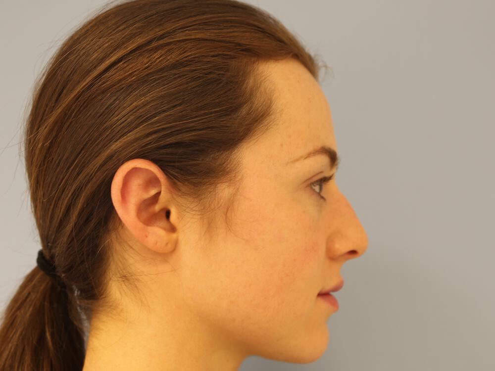 Nose reshaping women Before & After Image
