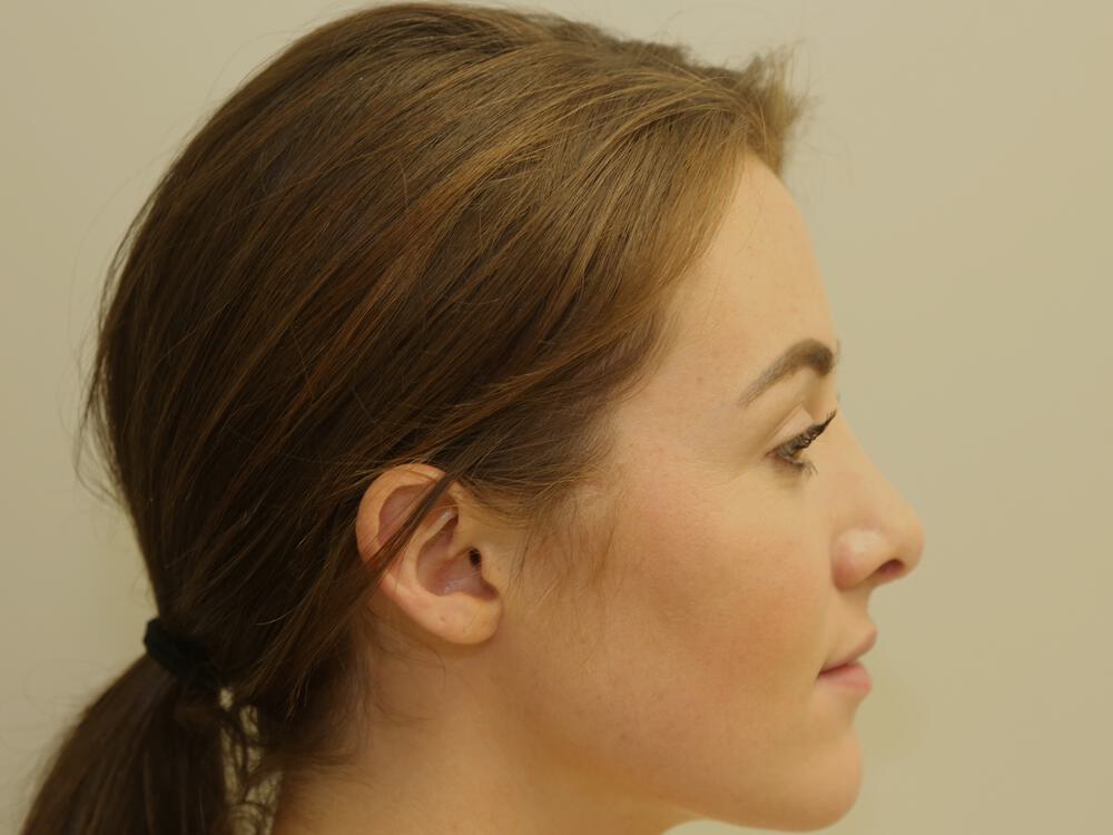 Nose reshaping women Before & After Image
