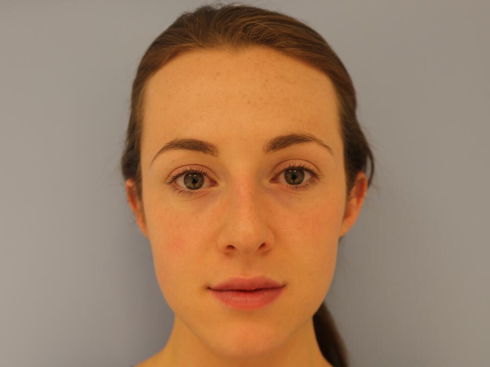 Rhinoplasty Before & After Image