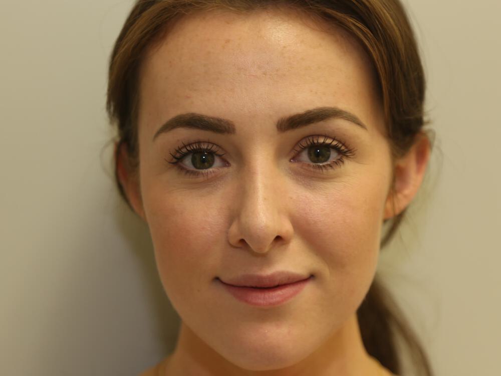 Rhinoplasty Before & After Image