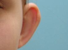 Prominent Ears Before & After Image