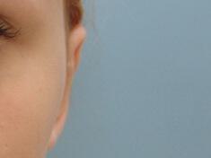 Prominent Ears Before & After Image