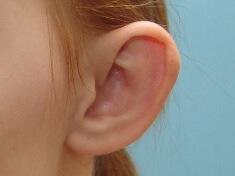 Prominent Ears Before & After Image