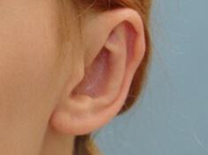Prominent Ears Before & After Image