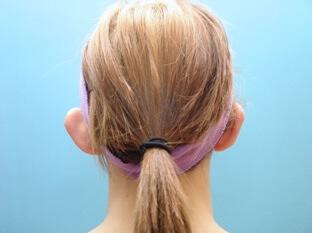 Prominent Ears Before & After Image