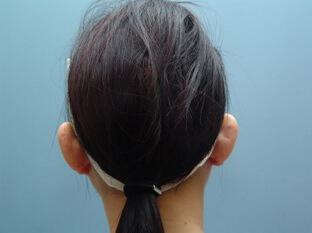 Prominent Ears Before & After Image