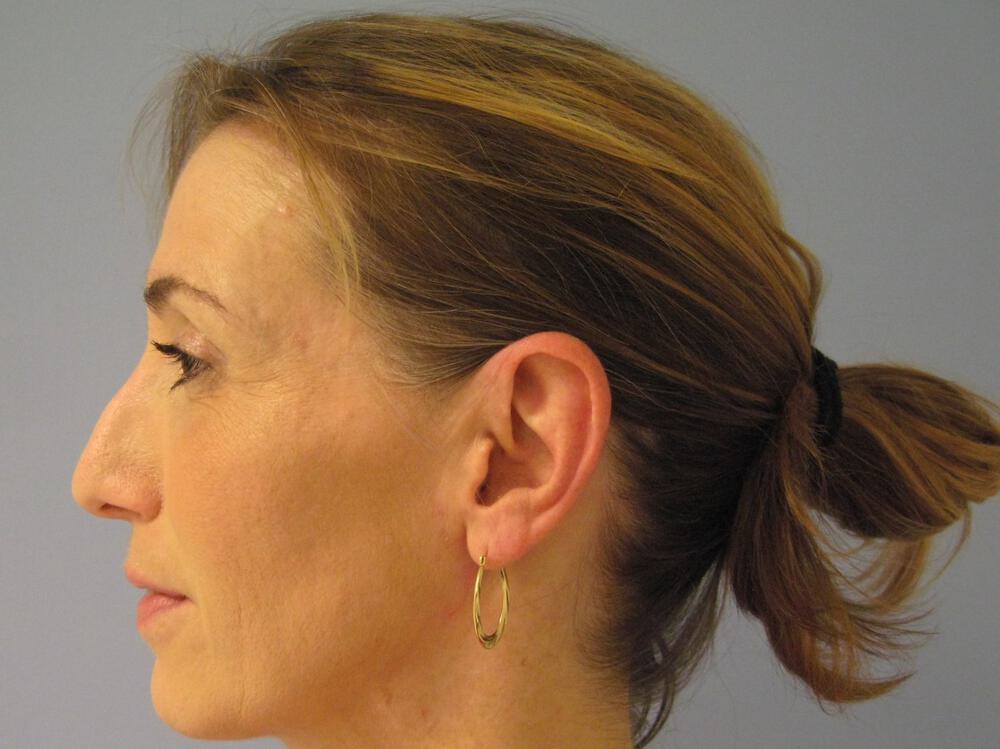 Revision Rhinoplasty Before & After Image