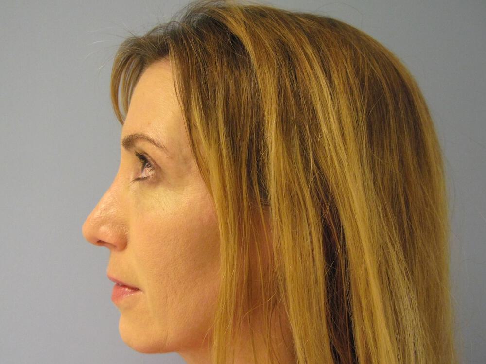 Revision Rhinoplasty Before & After Image