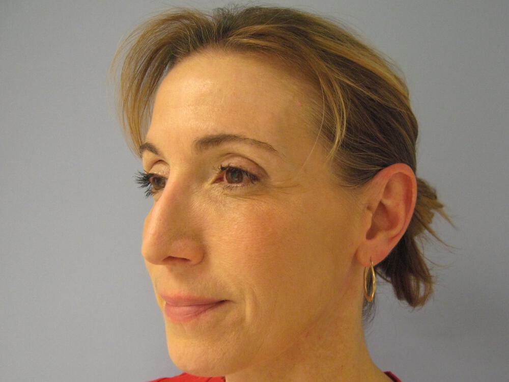 Revision Rhinoplasty Before & After Image