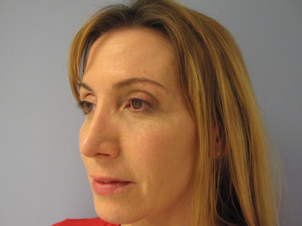 Revision Rhinoplasty Before & After Image