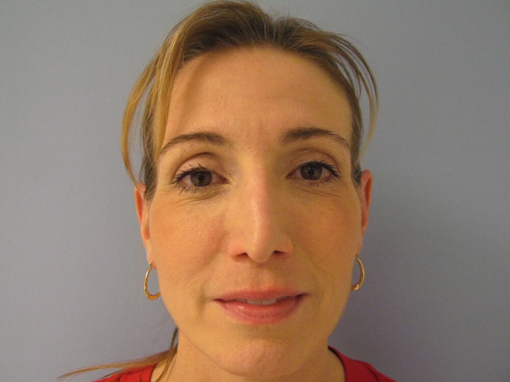 Revision Rhinoplasty Before & After Image