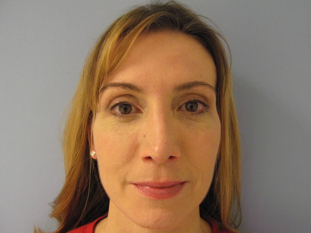 Revision Rhinoplasty Before & After Image