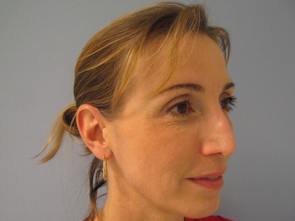 Revision Rhinoplasty Before & After Image