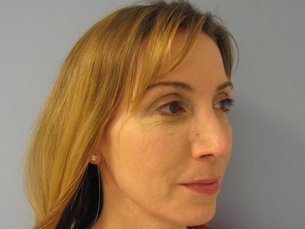 Revision Rhinoplasty Before & After Image