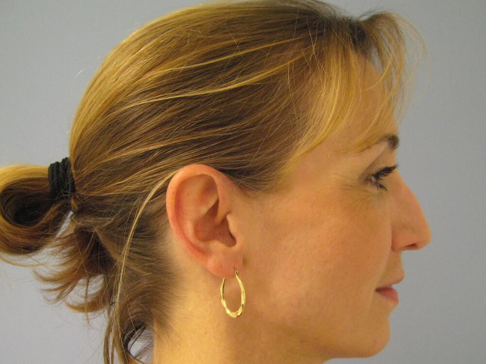 Revision Rhinoplasty Before & After Image