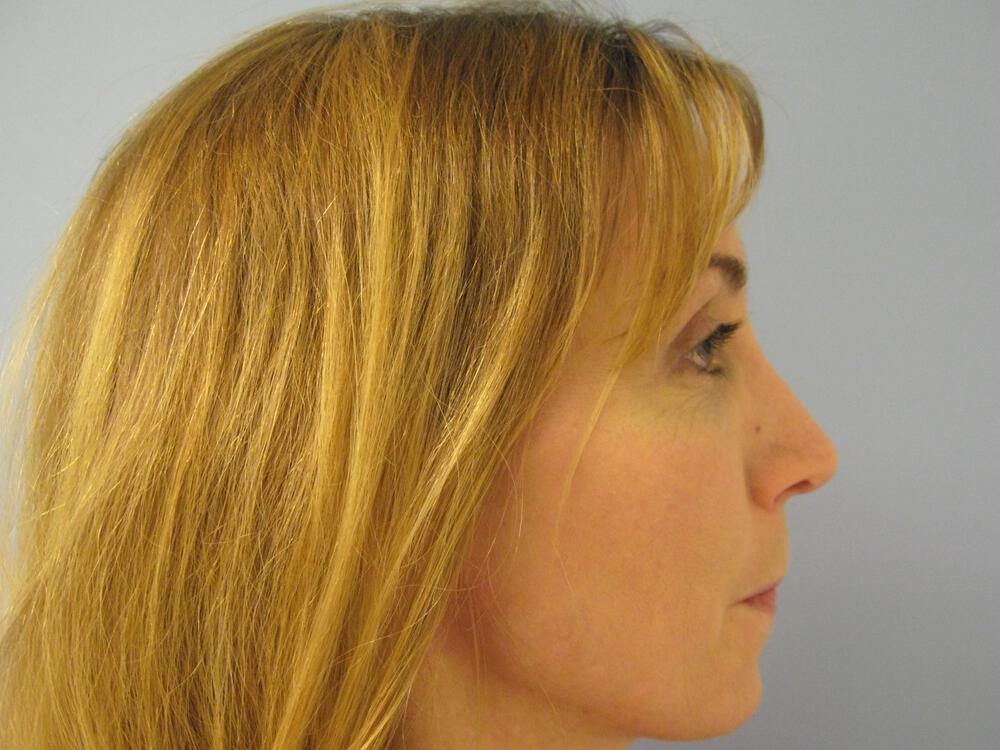 Revision Rhinoplasty Before & After Image