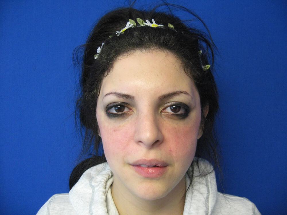 Revision Rhinoplasty Before & After Image