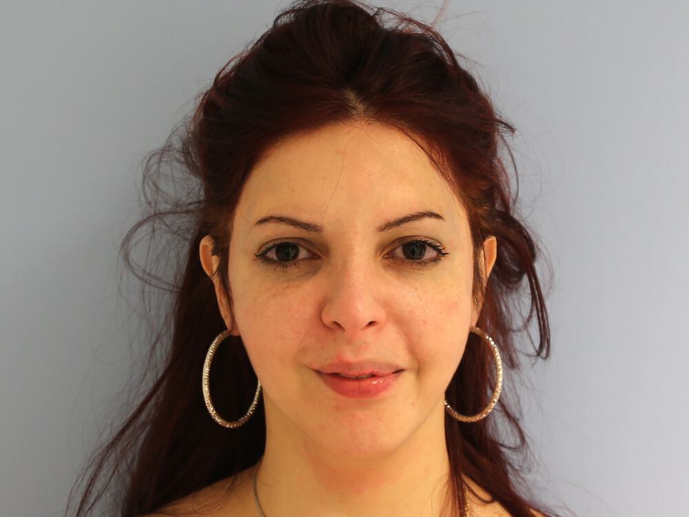 Revision Rhinoplasty Before & After Image