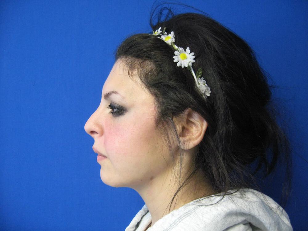 Revision Rhinoplasty Before & After Image