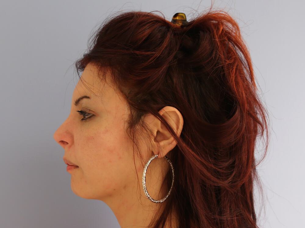 Revision Rhinoplasty Before & After Image
