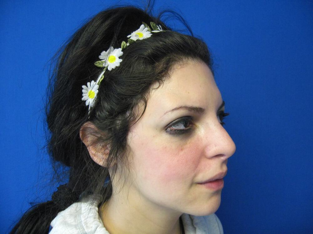 Revision Rhinoplasty Before & After Image