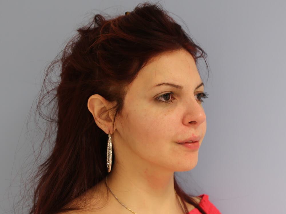 Revision Rhinoplasty Before & After Image