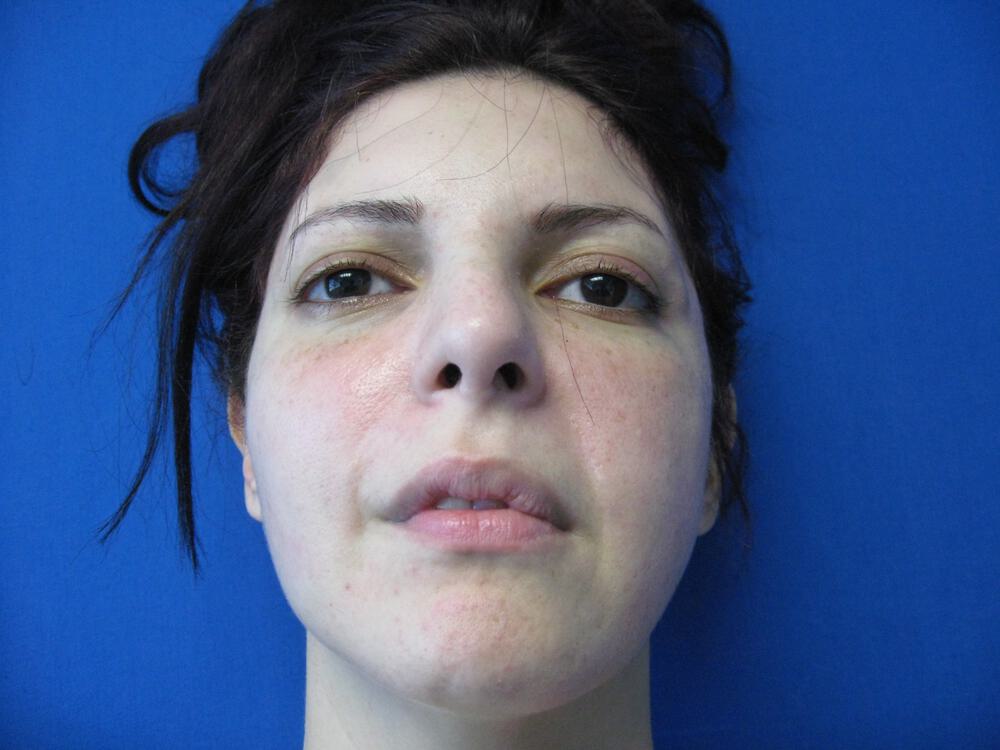 Revision Rhinoplasty Before & After Image