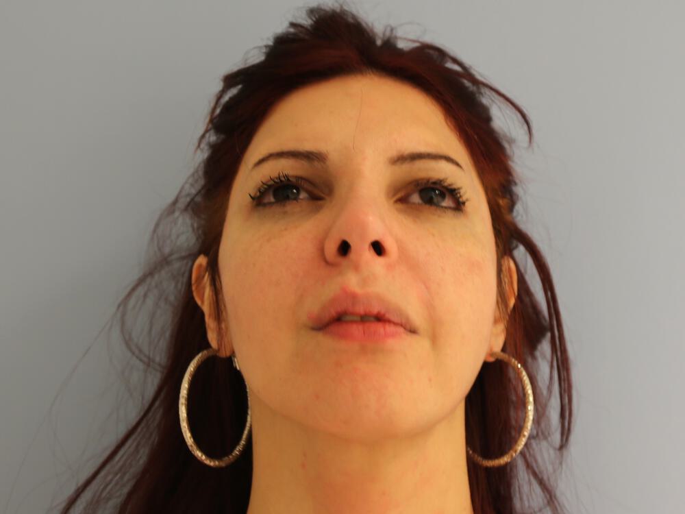 Revision Rhinoplasty Before & After Image