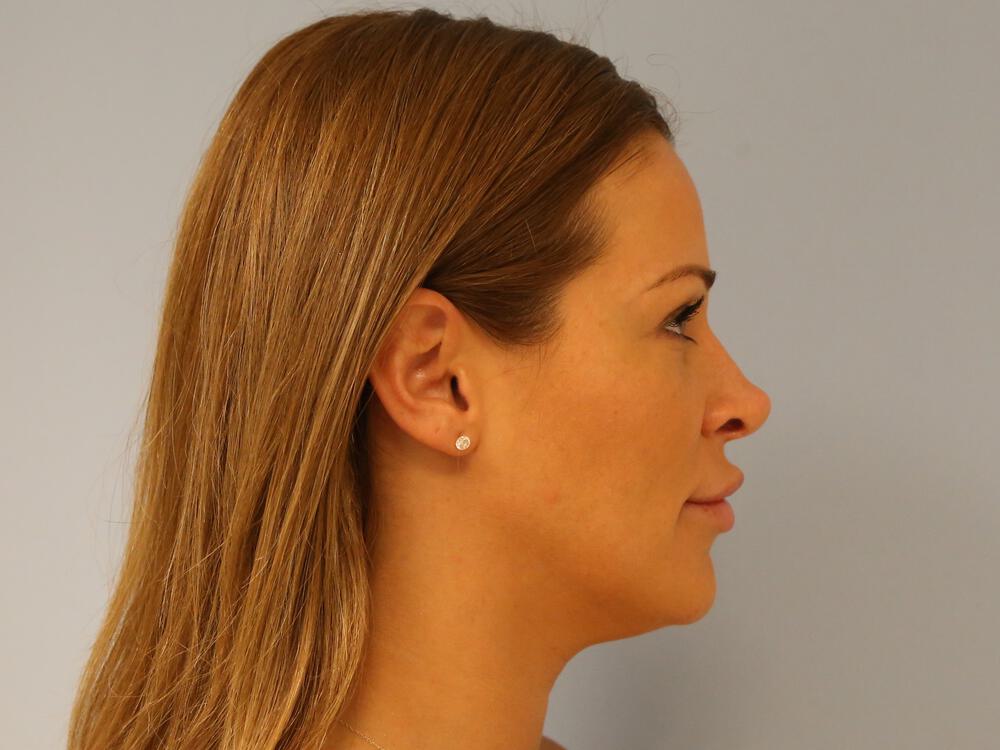 Revision rhinoplasty Before & After Image