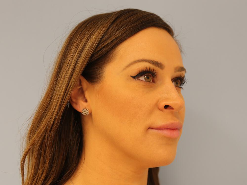 Revision rhinoplasty Before & After Image