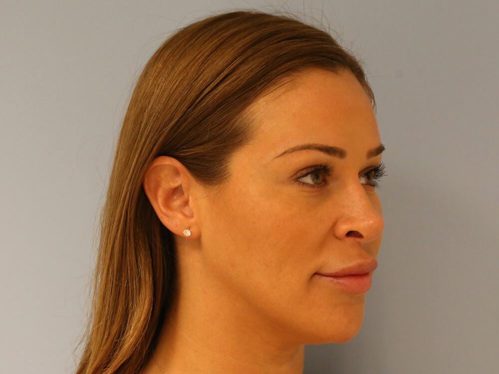 Revision rhinoplasty Before & After Image