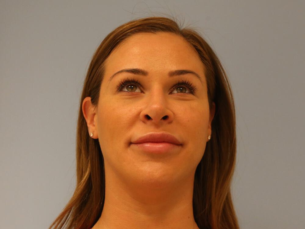 Revision Rhinoplasty Before & After Image