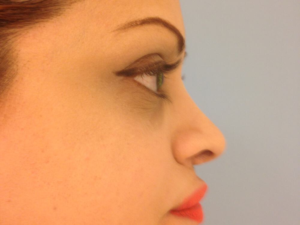 Revision rhinoplasty Before & After Image