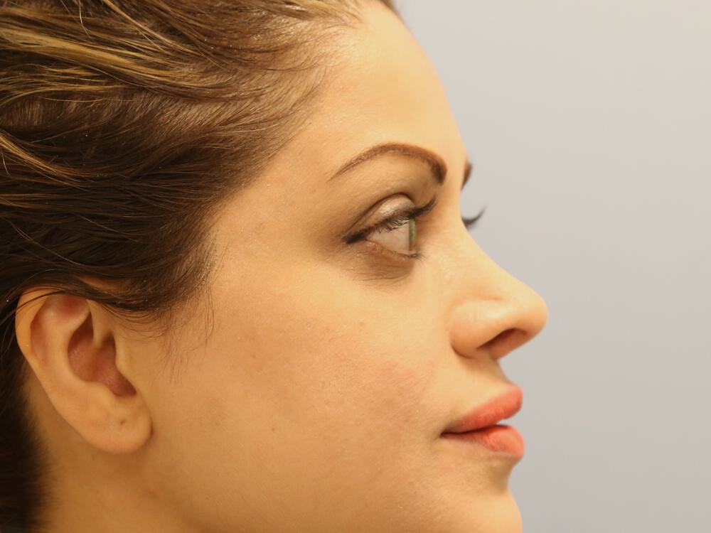 Revision rhinoplasty Before & After Image