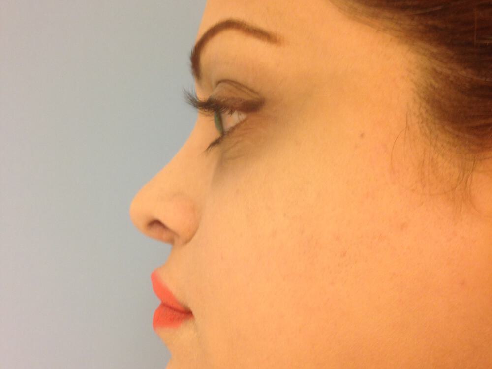 Revision rhinoplasty Before & After Image