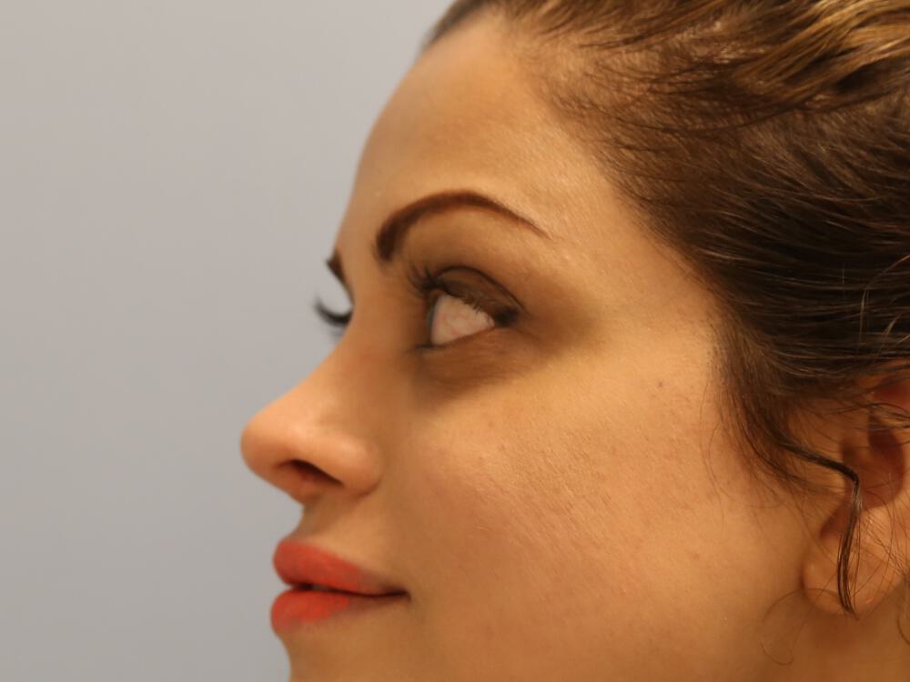 Revision rhinoplasty Before & After Image