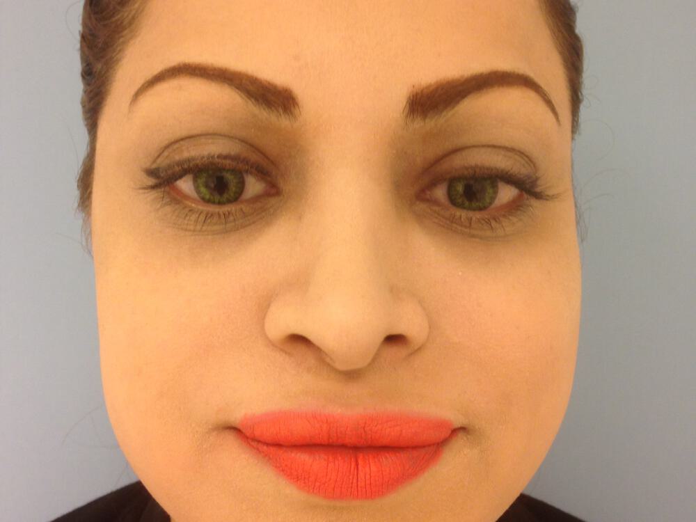 Revision Rhinoplasty Before & After Image