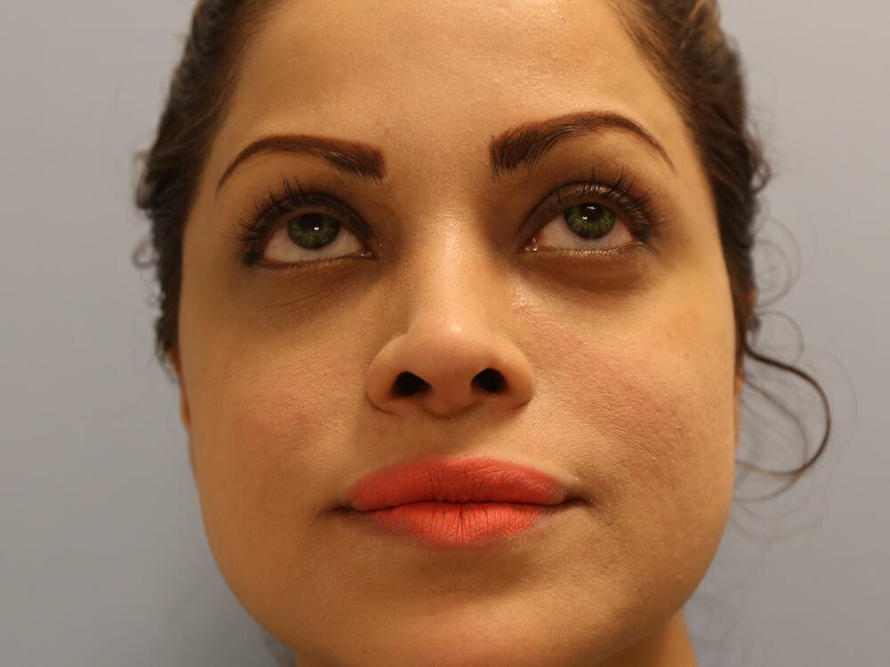 Revision Rhinoplasty Before & After Image