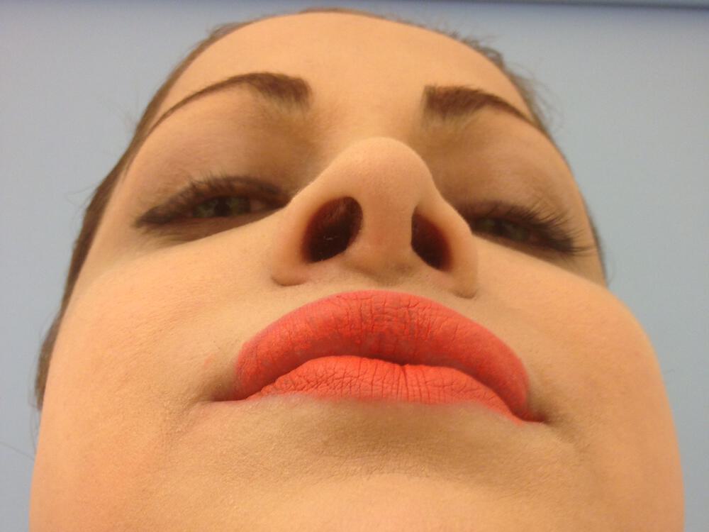 Revision Rhinoplasty Before & After Image