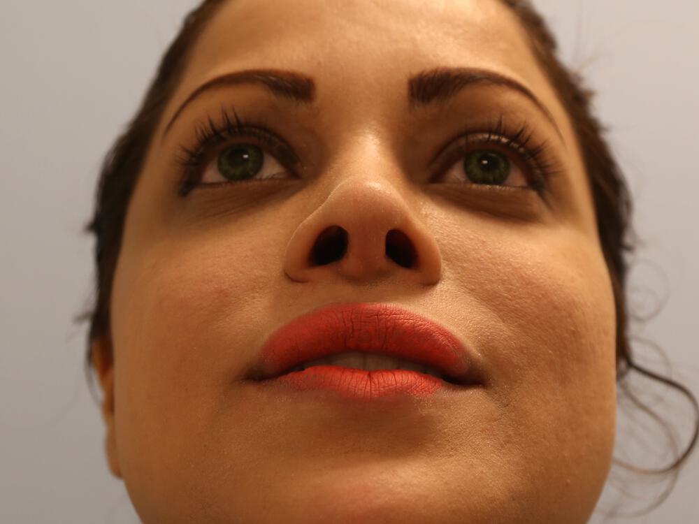 Revision Rhinoplasty Before & After Image