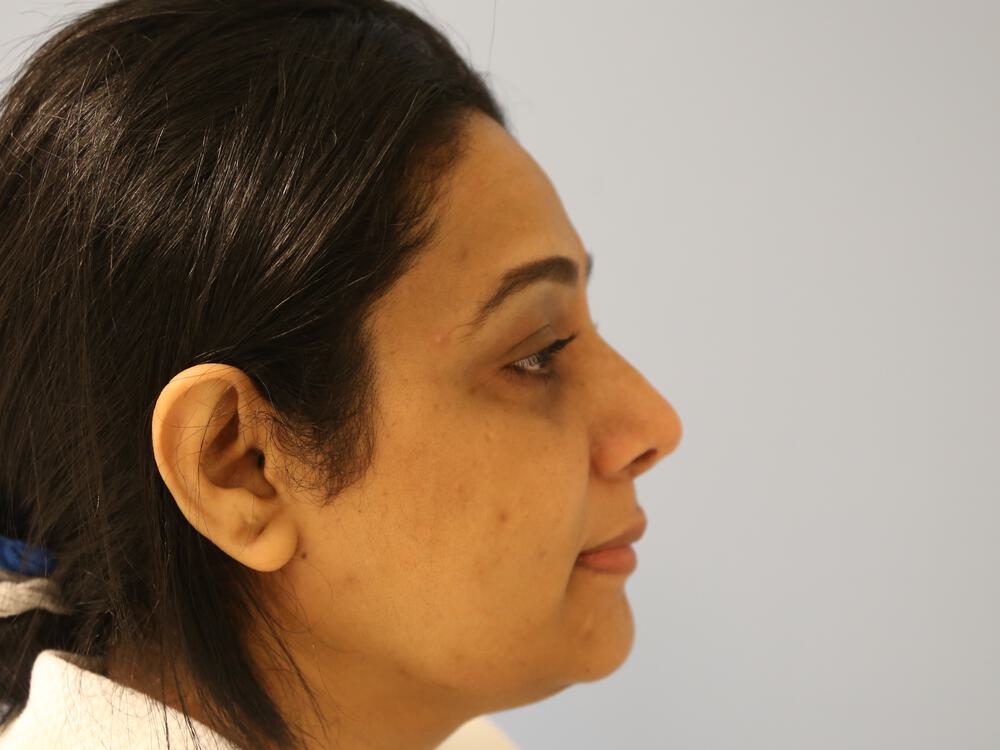 Revision rhinoplasty Before & After Image