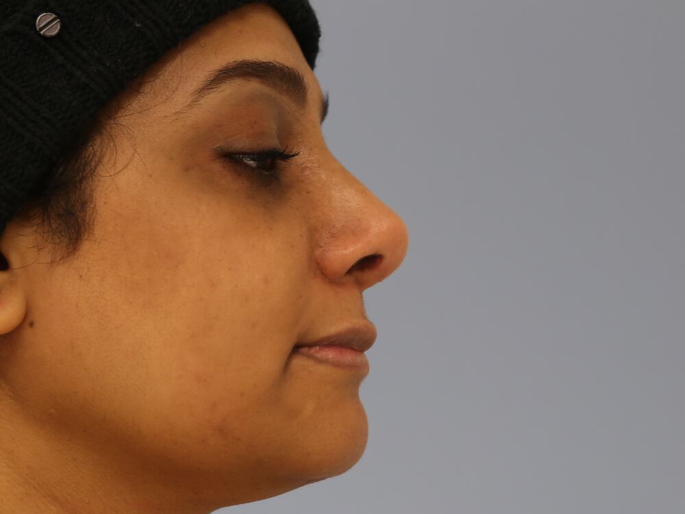 Revision rhinoplasty Before & After Image
