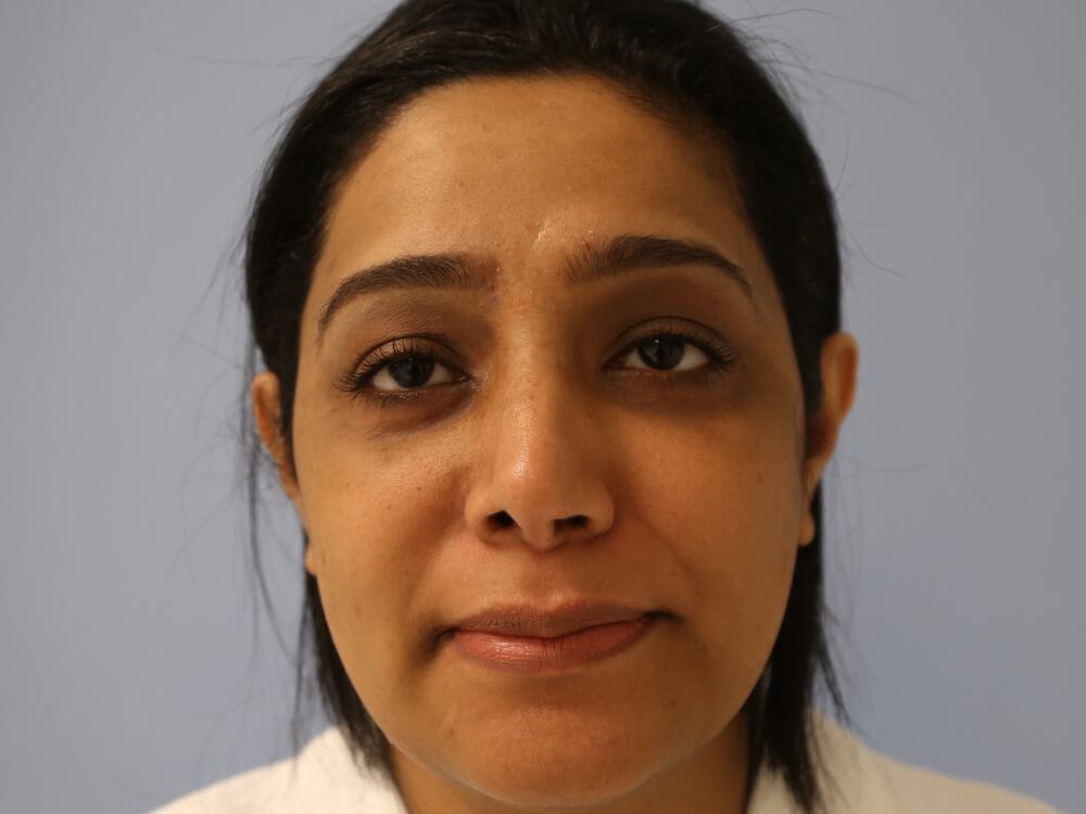 Revision rhinoplasty Before & After Image