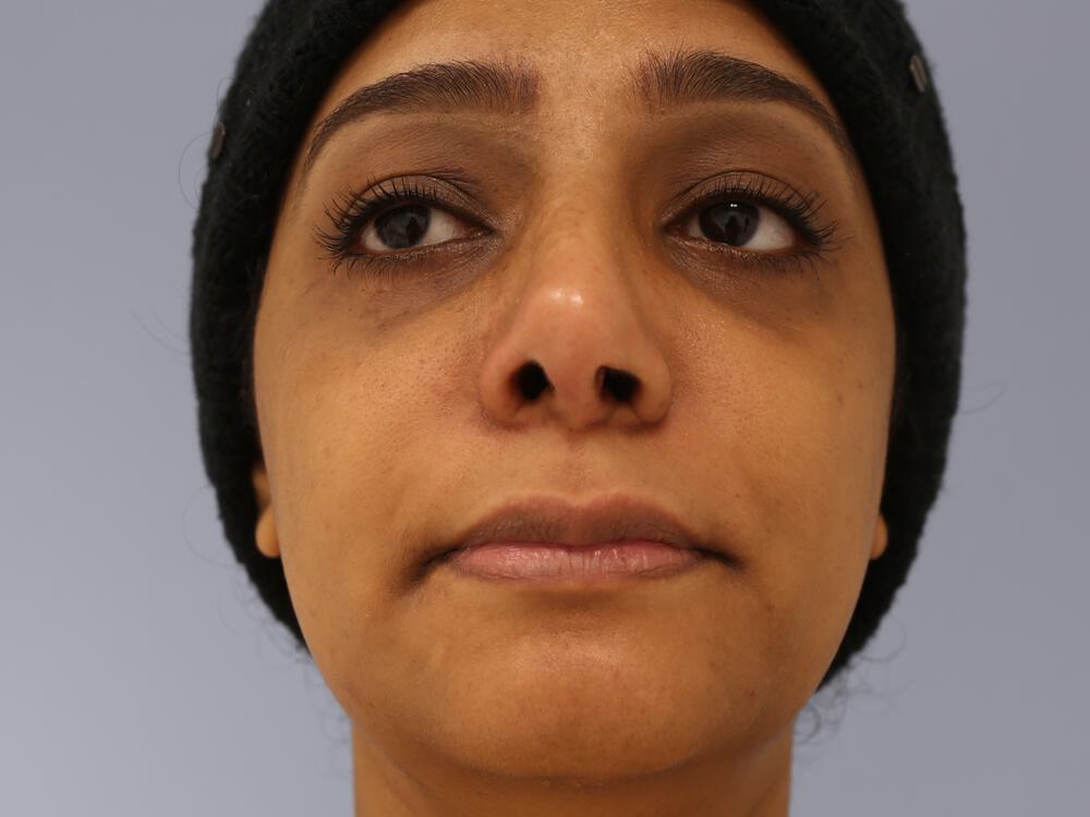 Revision rhinoplasty Before & After Image
