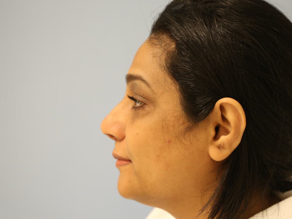 Revision Rhinoplasty Before & After Image